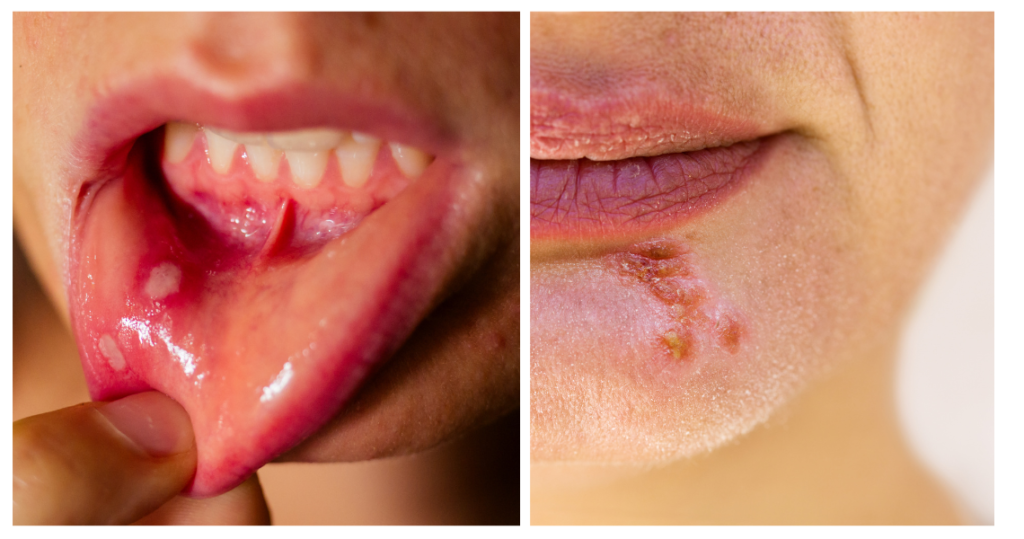 Herpes ali afta slike