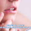 Herpes ali afta? Ključne razlike, simptomi in kaj pomaga