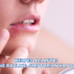 Herpes ali afta? Ključne razlike, simptomi in kaj pomaga